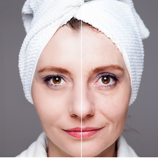 Skin rejuvenation Tightening